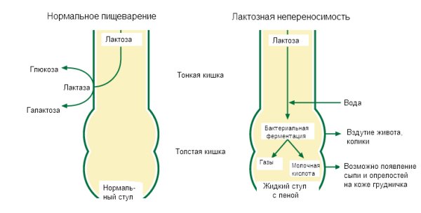 Лактозна недостатність у немовляти. Симптоми і особливості