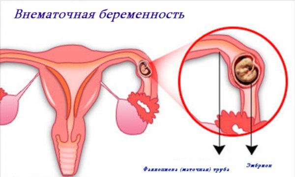 Симптоми позаматкової вагітності в перші дні