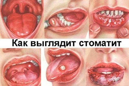 Як розвивається стоматит у грудничка: симптоми