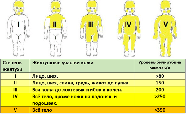 Желтушка у новонароджених причини і наслідки