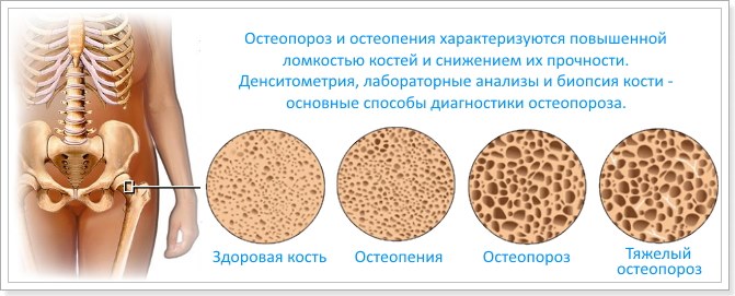 Остеопороз лікування народними засобами в літньому віці у жінок