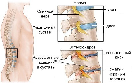 Симптоми і лікування поперекового радикуліту народними засобами