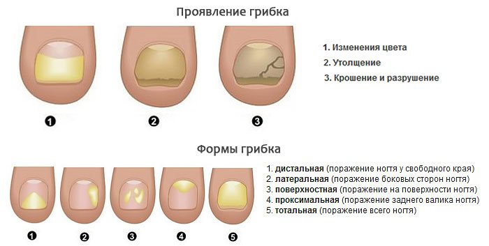 Якщо нігті ростуть хвилями: причини і лікування