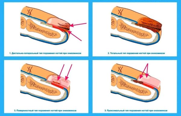Оніхомікоз нігтів, лікування. Препарати недорогі, але ефективні
