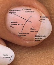 діагностика за станом нігтів