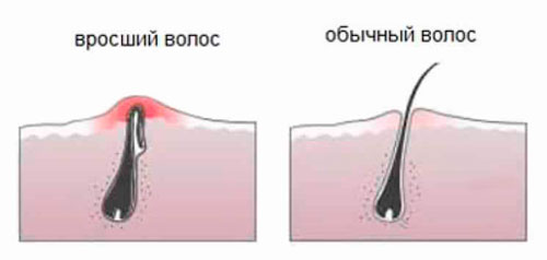 вростають волосся