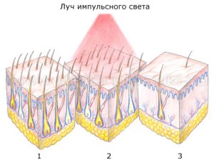 фотоепіляція плюси і мінуси